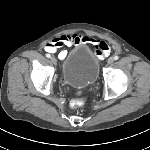 File:Abdominal wall metastasis from colorectal carcinoma (Radiopaedia 31016-31717 Axial C+ portal venous phase 68).jpg