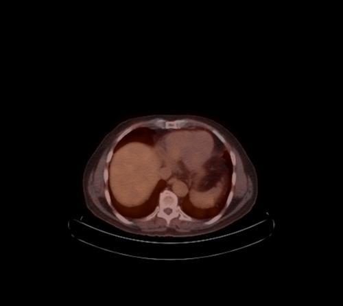 Abdominal wall metastasis from colorectal carcinoma (Radiopaedia 31016-31719 C 95).jpg