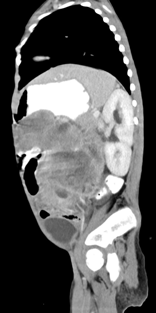 Abdominopelvic rhabdomyosarcoma (Radiopaedia 78356-90984 Sagittal C+ portal venous phase 29).jpg