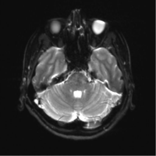 File:Abducens nerve palsy (Radiopaedia 51069-56648 Axial DWI 7).png