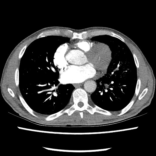 Accessory left horizontal fissure with lingular pneumonia (Radiopaedia 53763-59843 Axial C+ CTPA 57).jpg