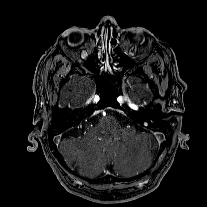 Accessory middle cerebral artery (Radiopaedia 73114-83828 Axial MRA 32).jpg