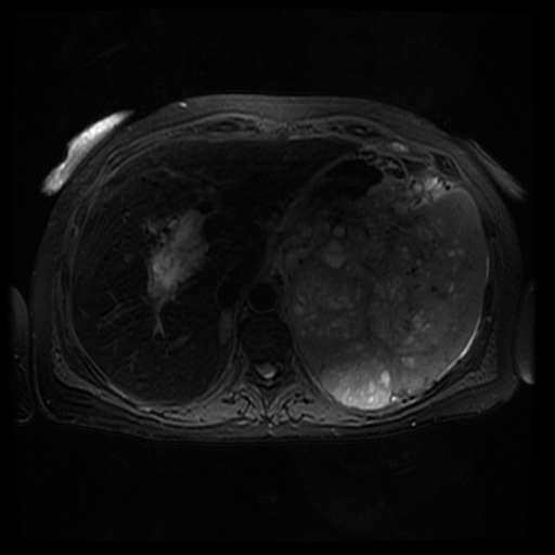 Acinar cell carcinoma of the pancreas (Radiopaedia 75442-86668 Axial T2 fat sat 22).jpg