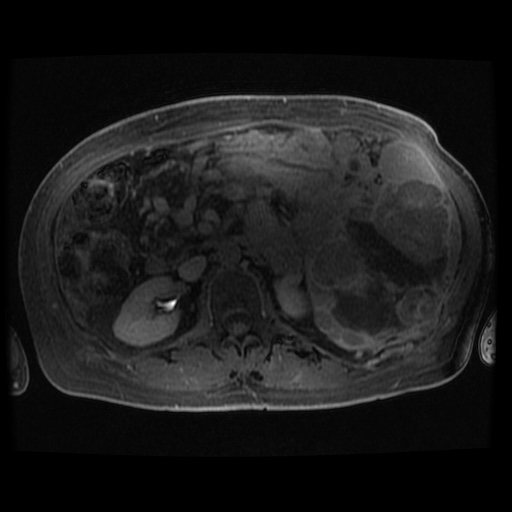 Acinar cell carcinoma of the pancreas (Radiopaedia 75442-86668 Axial late phase (~30 mins) 43).jpg