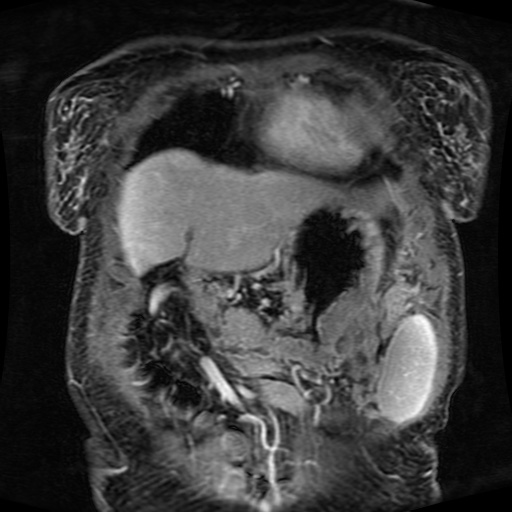 File:Acinar cell carcinoma of the pancreas (Radiopaedia 75442-86668 Coronal T1 C+ fat sat 153).jpg