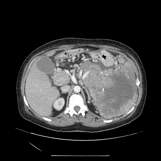 Acinar cell carcinoma of the pancreas (Radiopaedia 75442-86669 Axial C+ portal venous phase 44).jpg