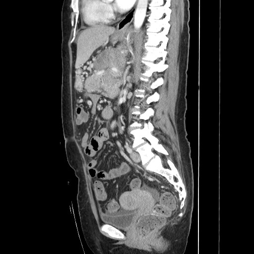 File:Acinar cell carcinoma of the pancreas (Radiopaedia 75442-86669 Sagittal C+ portal venous phase 106).jpg