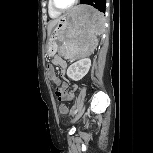 File:Acinar cell carcinoma of the pancreas (Radiopaedia 75442-86669 Sagittal C+ portal venous phase 127).jpg