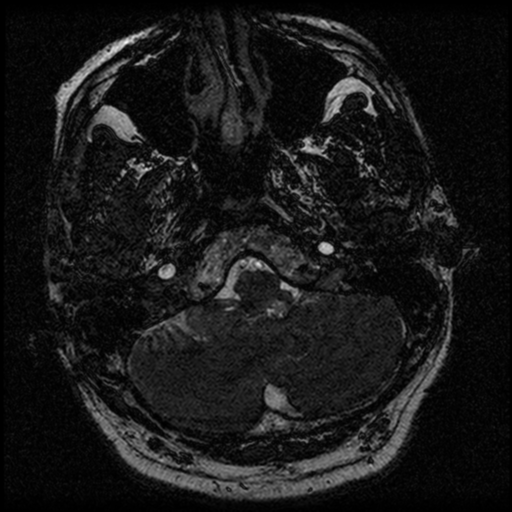 File:Acoustic schwannoma (Radiopaedia 39170-41387 Axial FIESTA 34).png