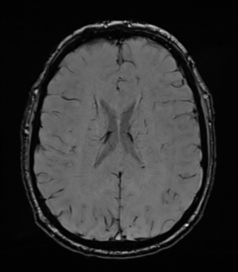 Acoustic schwannoma (Radiopaedia 50846-56358 Axial SWI 58).png