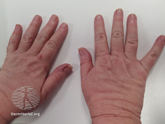 File:Acral persistent papular mucinosis (DermNet NZ acral-persistent-papular-mucinosis-01).jpg