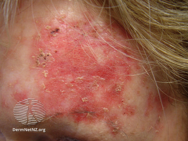 Actinic Keratoses treated with imiquimod (DermNet NZ lesions-ak-imiquimod-3726).jpg