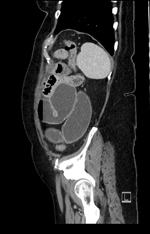 Active Crohn disease (Radiopaedia 59394-66750 Sagittal C+ portal venous phase 11).jpg