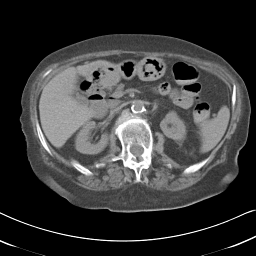 Active bleeding from duodenal ulcer with embolization (Radiopaedia 34216-35481 Axial non-contrast 24).png