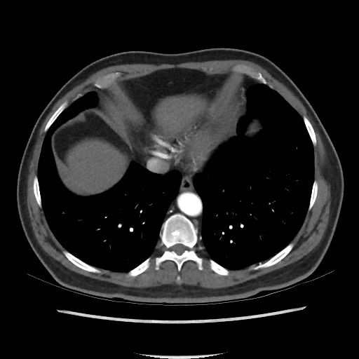 File:Active colonic bleed on CT (Radiopaedia 49765-55025 Axial C+ arterial phase 8).jpg