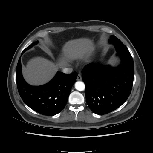 Active colonic bleed on CT (Radiopaedia 49765-55025 Axial C+ arterial phase 9).jpg