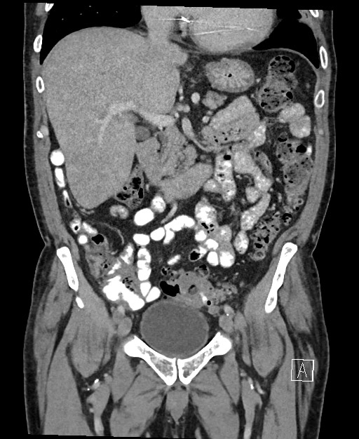 Active lower gastrointestinal bleeding - diverticular (Radiopaedia 61203-69106 Coronal C+ portal venous phase 60).jpg