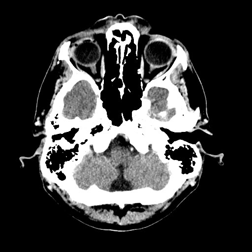 File:Active neurocysticercosis before and after therapy (Radiopaedia 71710-82099 Axial C+ delayed 86).jpg