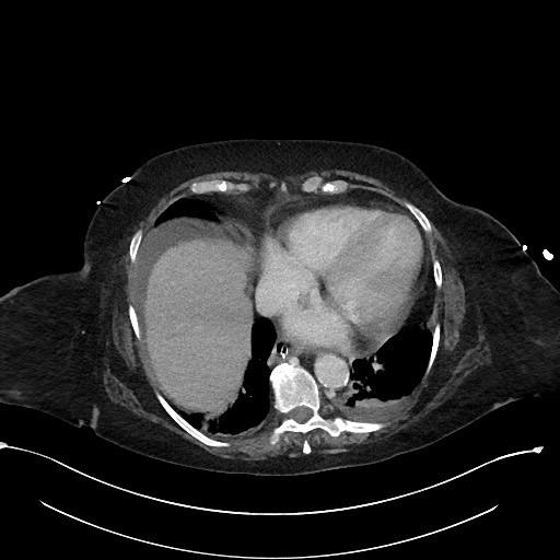 File:Active renal extravasation with large subcapsular and retroperitoneal hemorrhage (Radiopaedia 60975-68796 Axial 343).jpg