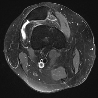 File:Acute-on-chronic transient lateral patellar dislocation with trochlear dysplasia (Radiopaedia 84099-99349 Axial PD fat sat 7).jpg