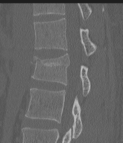 Acute L1 burst compression fracture (Radiopaedia 34430-35755 Sagittal bone window 29).png