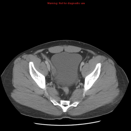 Acute appendicitis (Radiopaedia 10498-10973 Axial C+ portal venous phase 47).jpg