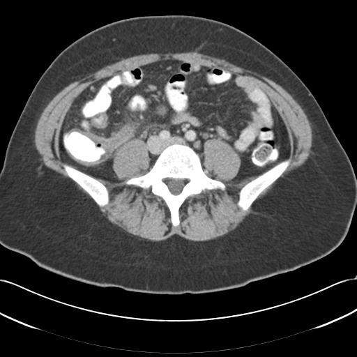 File:Acute appendicitis (Radiopaedia 30297-30934 Axial C+ portal venous phase 52).jpg