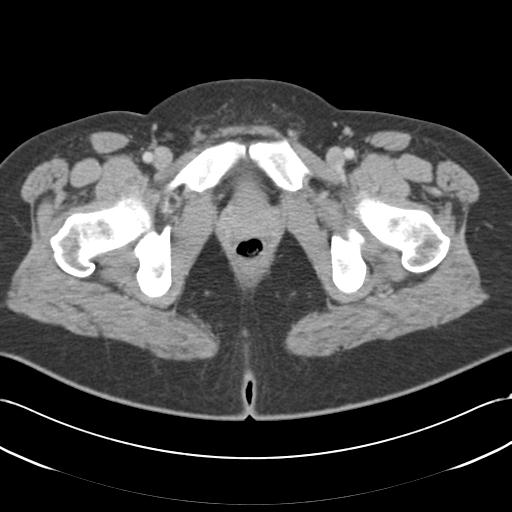 Acute appendicitis (Radiopaedia 30297-30934 Axial C+ portal venous phase 82).jpg