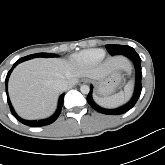 Acute appendicitis (Radiopaedia 32614-33572 Axial C+ portal venous phase 6).jpg
