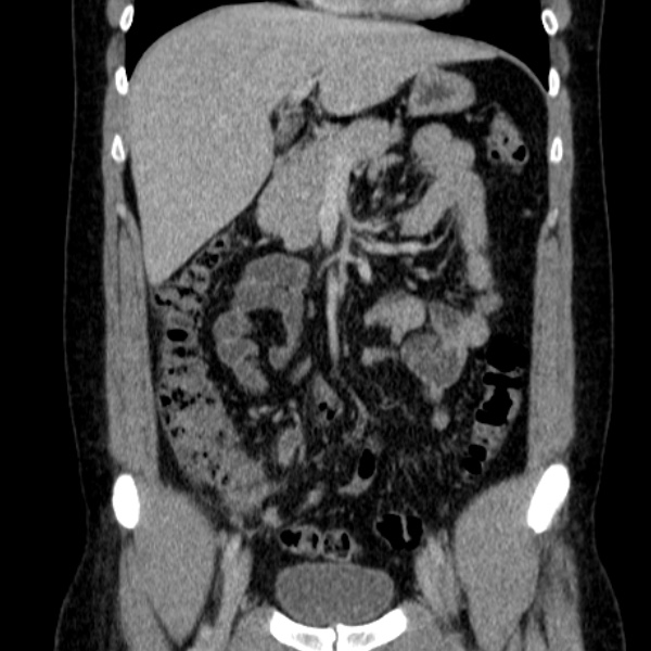 Acute appendicitis (Radiopaedia 38255-40270 Coronal C+ portal venous phase 36).jpg