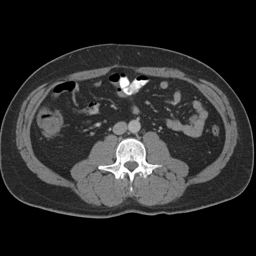 Acute appendicitis (Radiopaedia 48511-53463 Axial C+ portal venous phase 53).jpg
