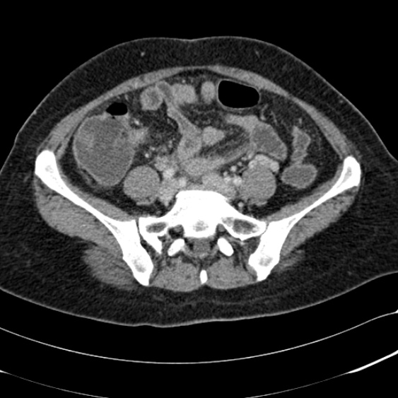 File:Acute appendicitis (Radiopaedia 48792-53822 Axial C+ portal venous phase 80).jpg