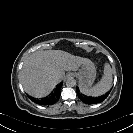 File:Acute appendicitis (Radiopaedia 58627-65818 Axial non-contrast 16).jpg
