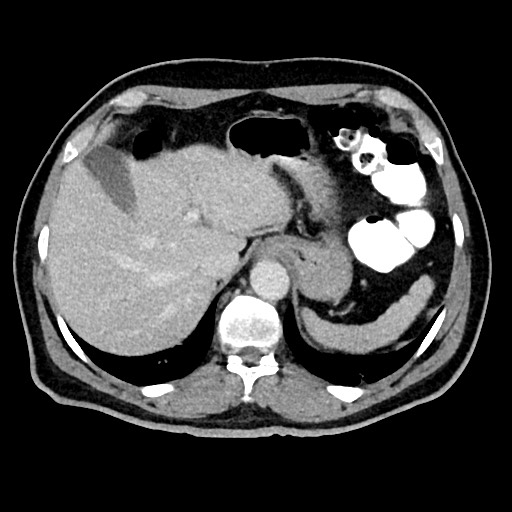 Acute appendicitis (Radiopaedia 77016-88960 Axial C+ portal venous phase 31).jpg