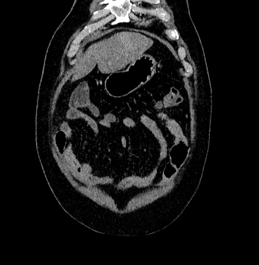 Acute appendicitis (Radiopaedia 79950-93224 Coronal C+ portal venous phase 12).jpg