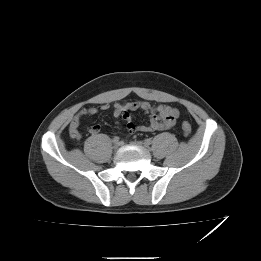 File:Acute appendicitis (Radiopaedia 81320-95015 A 8).jpg
