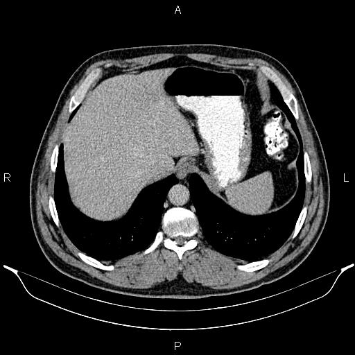 File:Acute appendicitis (Radiopaedia 84780-100240 Axial C+ portal venous phase 17).jpg