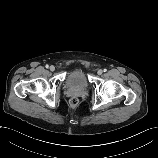 Acute appendicitis - large appendicoliths (Radiopaedia 61805-69820 Axial C+ portal venous phase 128).jpg