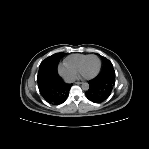 Acute appendicitis and COVID 19 pneumonia (Radiopaedia 76604-88380 Axial non-contrast 38).jpg