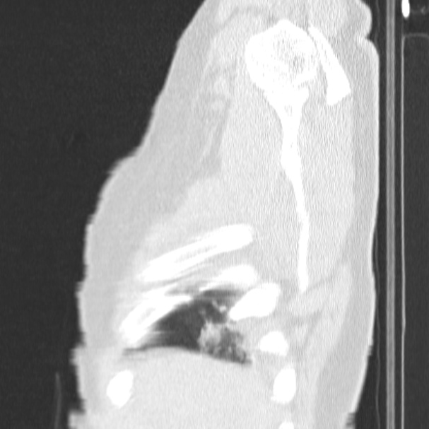 Acute aspiration pneumonitis (Radiopaedia 33605-34703 Sagittal lung window 10).jpg