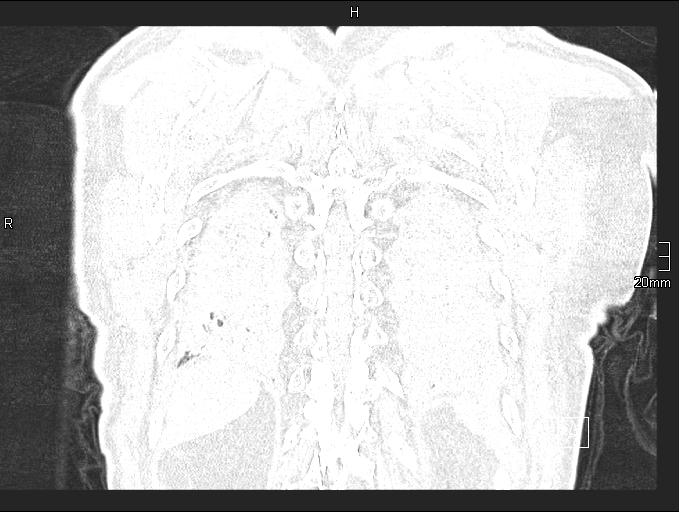 Acute aspiration pneumonitis (Radiopaedia 55642-62166 Coronal lung window 92).jpg