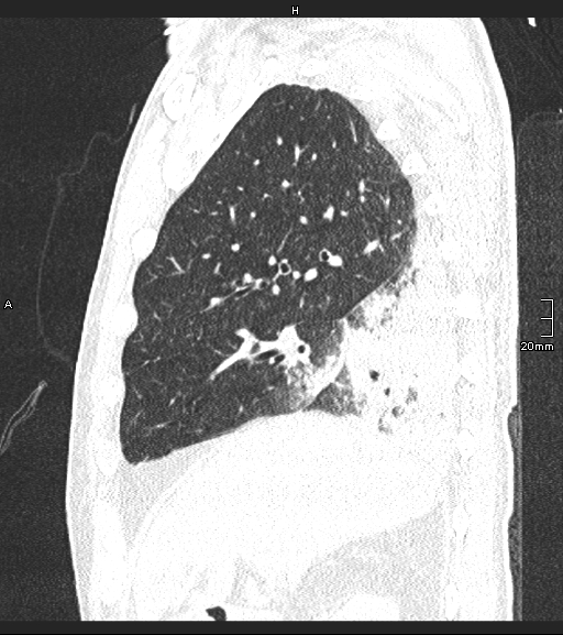 File:Acute aspiration pneumonitis (Radiopaedia 55642-62166 Sagittal lung window 107).jpg
