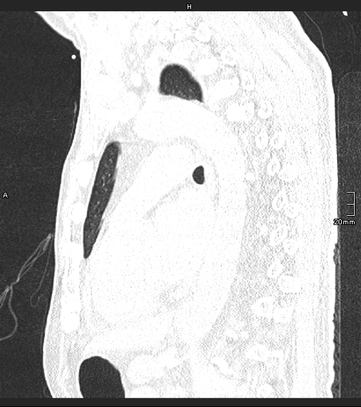 Acute aspiration pneumonitis (Radiopaedia 55642-62166 Sagittal lung window 63).jpg