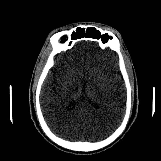 File:Acute basilar artery occlusion (Radiopaedia 43582-46985 Axial non-contrast 100).jpg