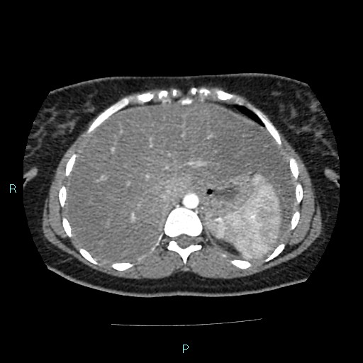 File:Acute bilateral pyelonephritis (Radiopaedia 37146-38881 Axial C+ arterial phase 24).jpg