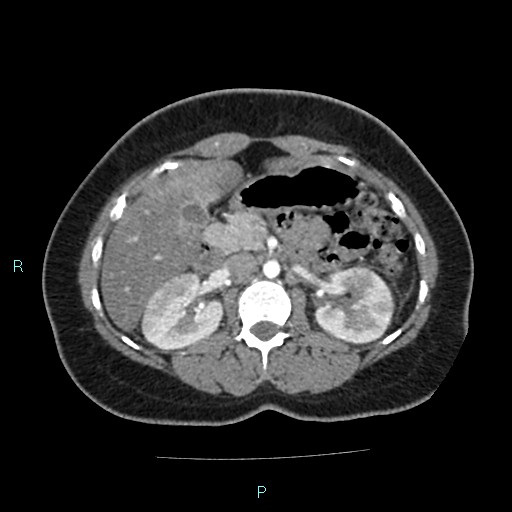 Acute bilateral pyelonephritis (Radiopaedia 37146-38881 Axial C+ arterial phase 73).jpg