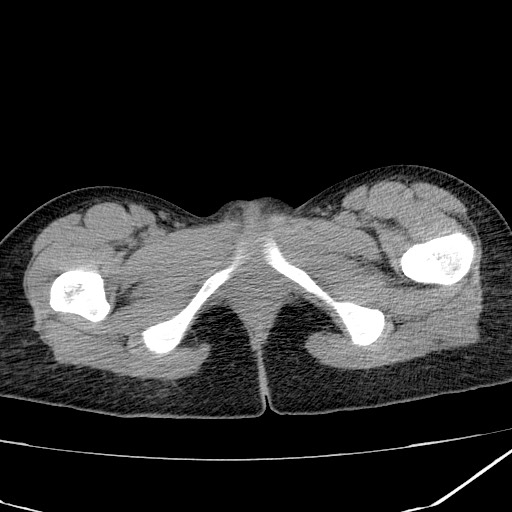 Acute bilateral pyelonephritis (Radiopaedia 74153-84969 Axial non-contrast 54).jpg