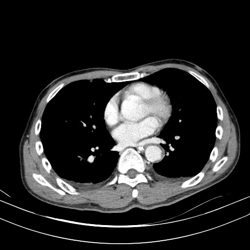 Acute bowel ischemia (Radiopaedia 87695-104114 Axial C+ portal venous phase 1).jpg