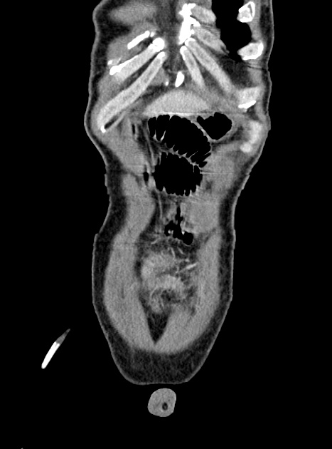 Acute bowel ischemia (Radiopaedia 87695-104114 Coronal C+ portal venous phase 79).jpg