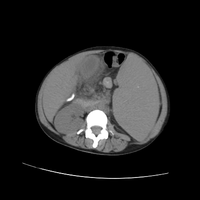 File:Acute calculous cholecystitis in patient with osteopetrosis (Radiopaedia 77871-90159 Axial non-contrast 43).jpg